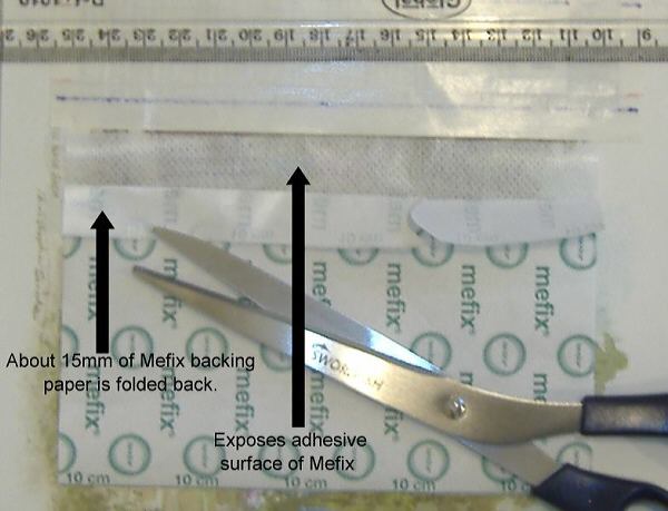 Restoring foreskin t-taping backing mefix tape Foreskin Restoration