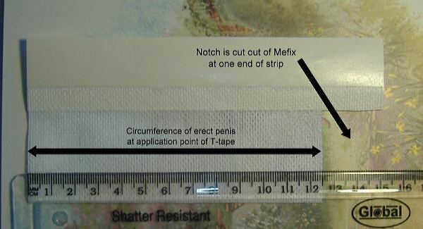 Foreskin restoration t-tape notch mefix tape with notch