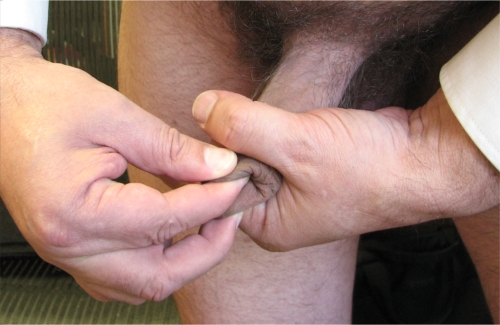 Squeeze-stretch manual tugging method for restoring foreskin