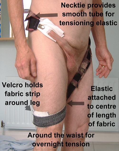 Foreskin restoration t-tape taped elastic around the waist
