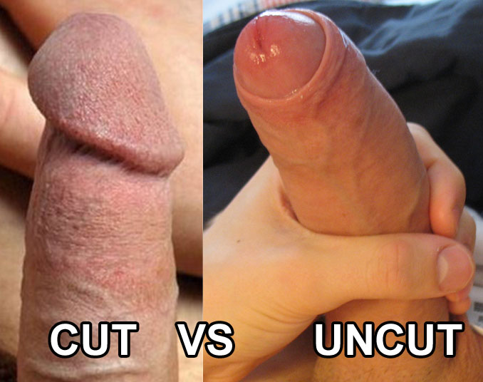 Dramatic comparison of keratinization on a cut penis verses an intact penis