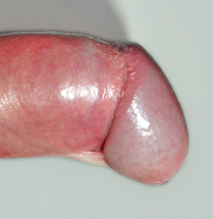 Penis with frenulum breve 