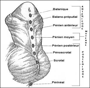 Hypospadias of the penis - Various locations of the urinary opening