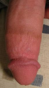 Example of circumcision scar