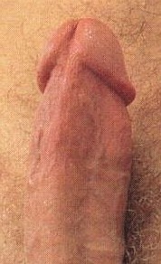 Penis with frenulum removed