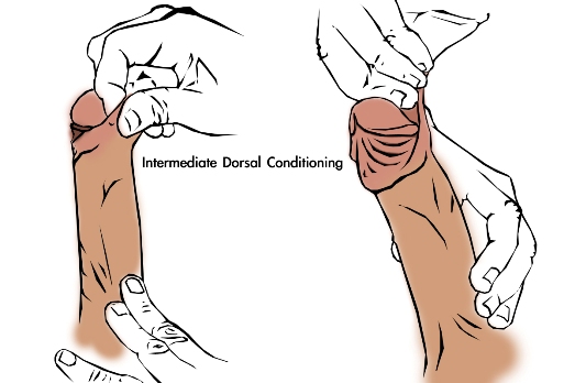 Method 1 manual tugging for stretching/tensioning the dorsal side of the penis foreskin