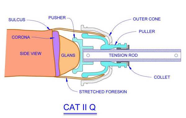 CATIIQ restoring device for foreskin restoration