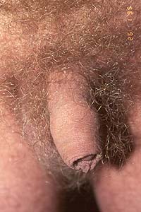 Intact penis showing foreskin over glans