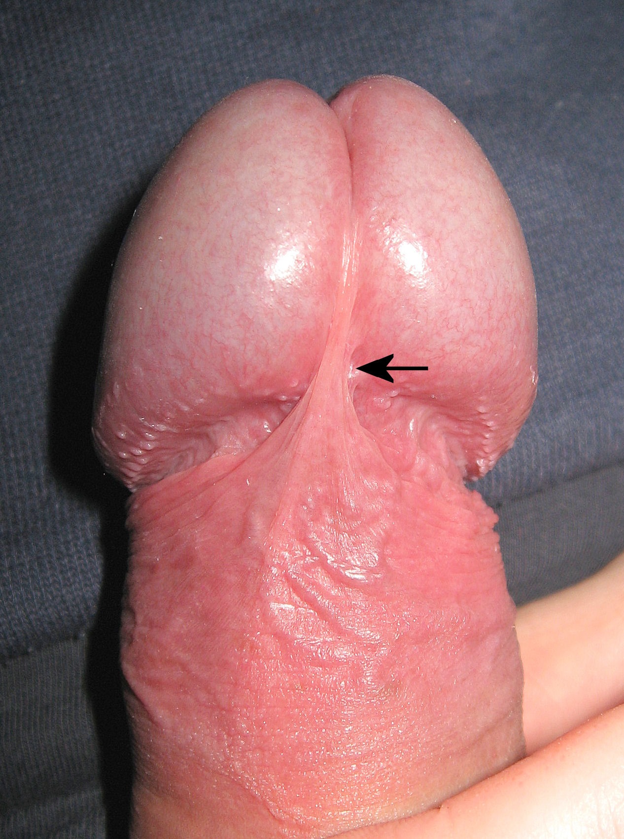 View of ventral side of glans penis showing an intact frenulum
