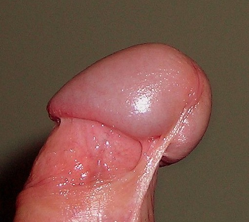 Side view of glans penis showing an intact frenulum