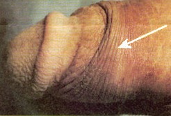 ridged band of the foreskin