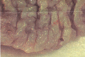 Magnified ridged band of the foreskin