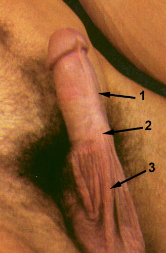 Scrotal Skin on Penis - Turkey Neck