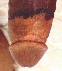 Example of uneven circumcision scar