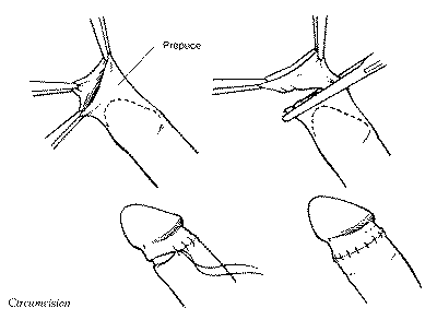 Illustration of freehand circumcision